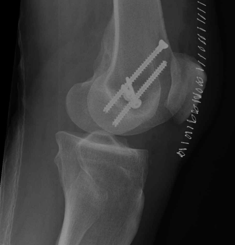 Hoffa Fracture Lateral